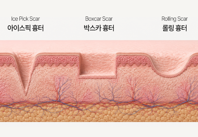 흉터 유형별 단면도