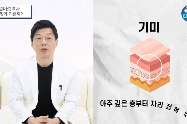 기미 흑자 차이 OO없이 받으면  재발하니 주의하세요