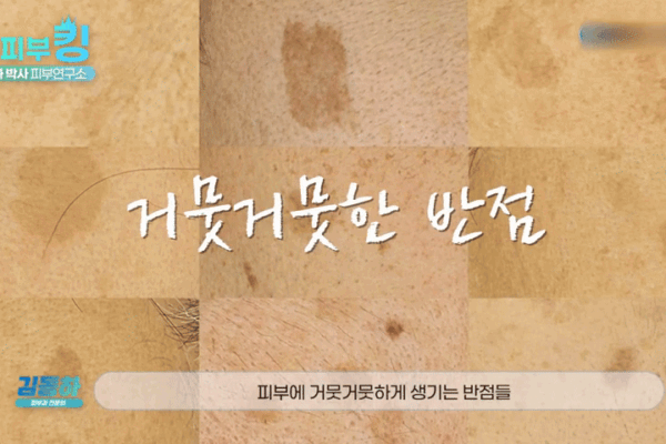 기미 흑자 차이, 신사피부과전문의가 말하는 정확한 OO의 중요성?
