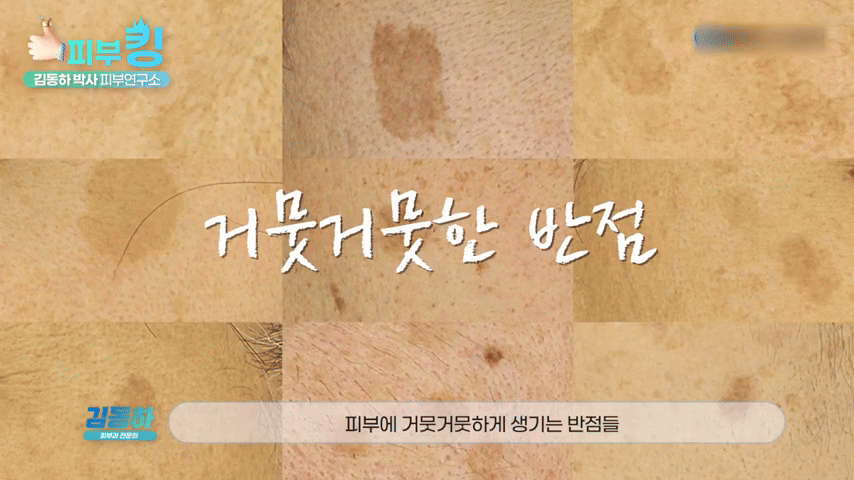 기미 흑자 차이, 신사피부과전문의가 말하는 정확한 OO의 중요성?