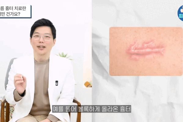 여드름패인흉터 레이저 잘하는 곳?  '이것' 모르면 돈과 시간만 날립니다