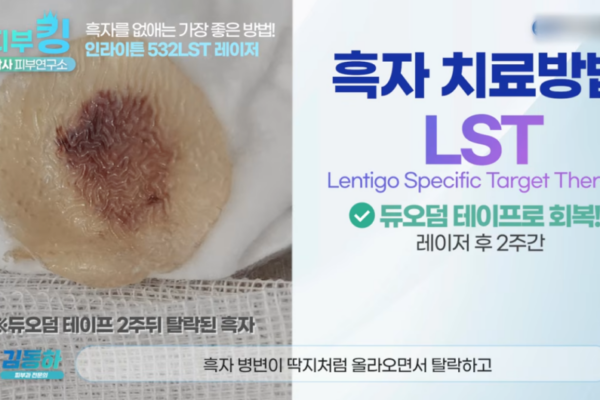 신사역피부과 흑자제거 레이저했는데 또 생겼다면? 흑자 재발을 줄이는 핵심