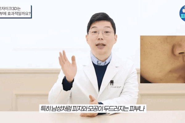 여드름 패인흉터 모자이크3D레이저? 기존 프락셔널 레이저와 '이것'이 완전히 다릅니다