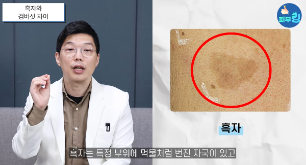 흑자검버섯 기미 차이?  피부과전문의가 알려드리는 정확한 구별법