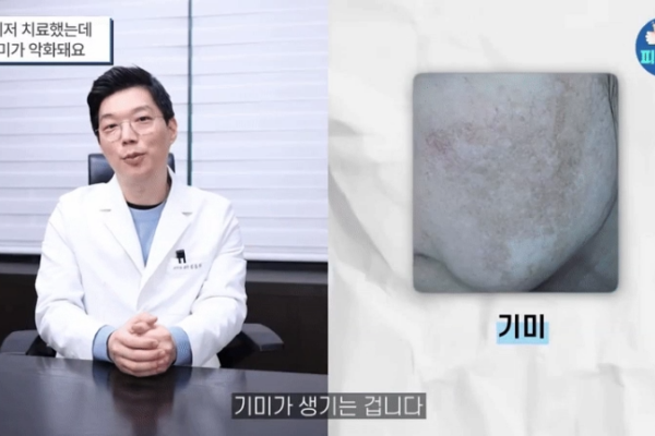 기미레이저 부작용?  레이저 토닝 시작하기 전 필수 체크사항 3가지